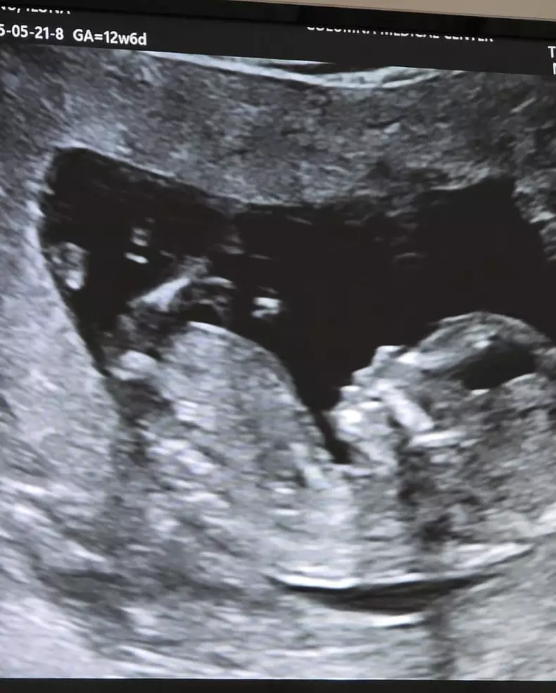 Ilona Brezoianu sarcină