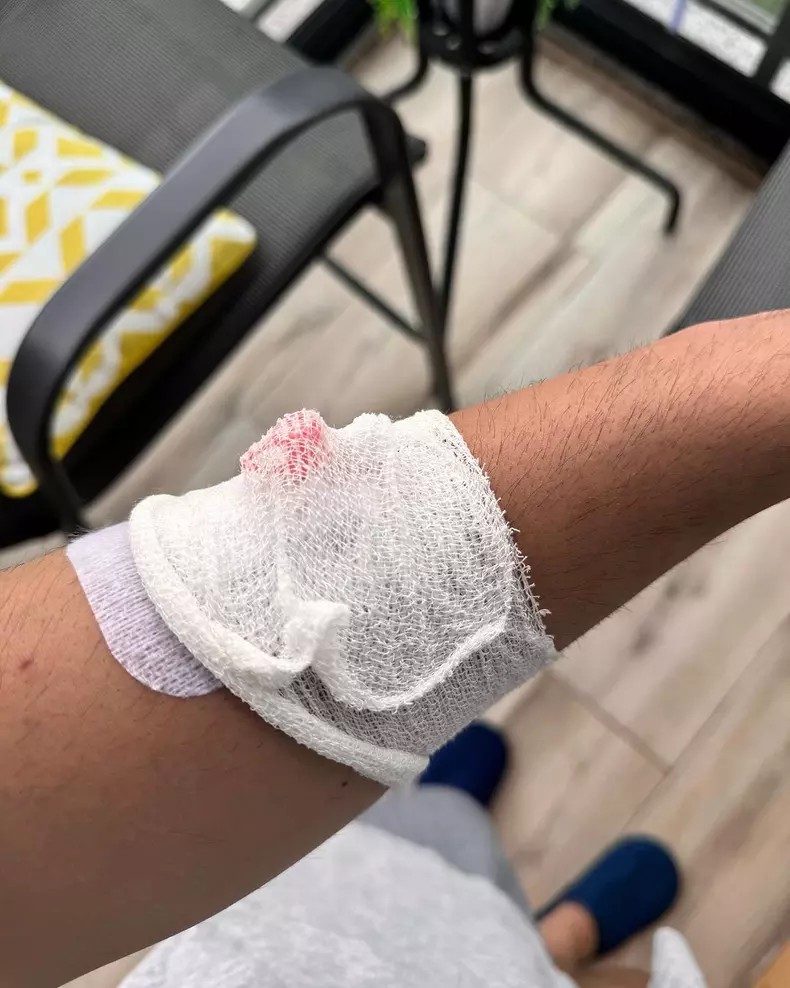 2. Vlad Gherman după implantul de păr