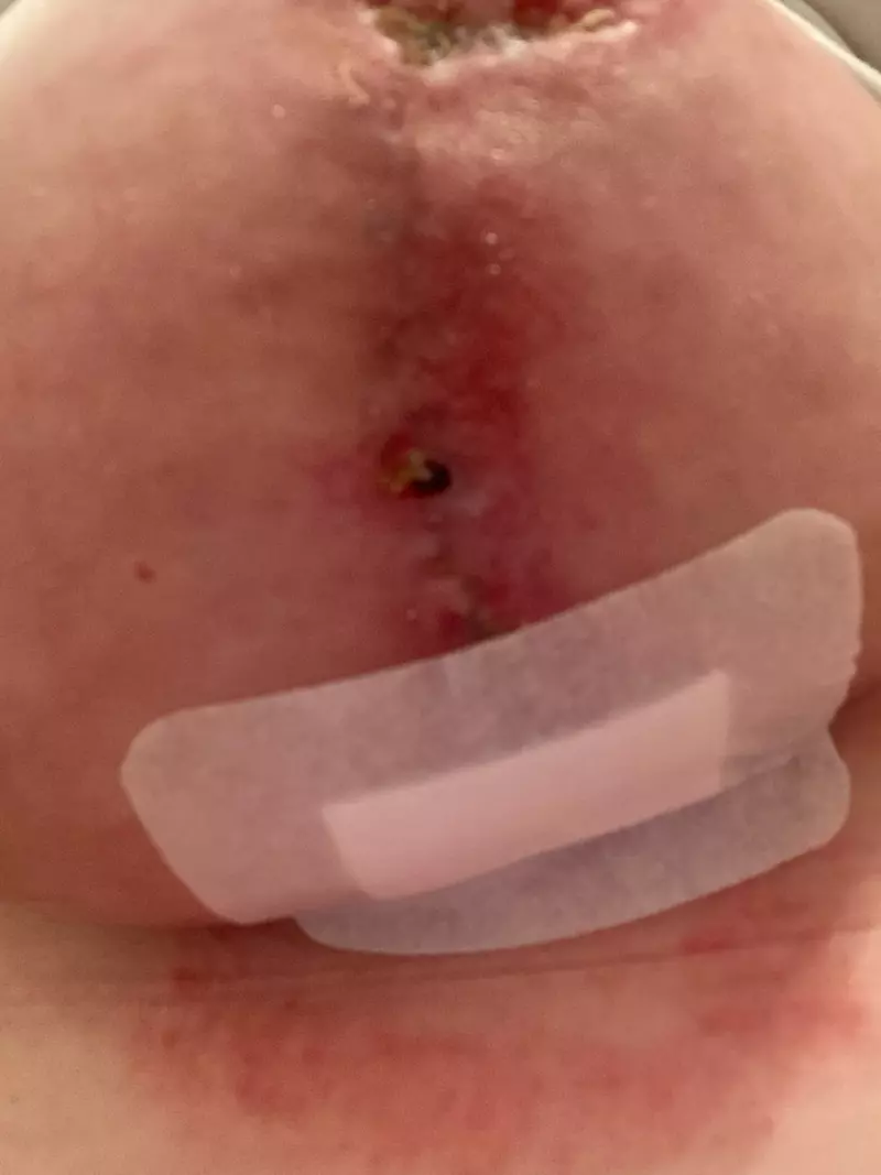 BOTCHED BOOB JOB