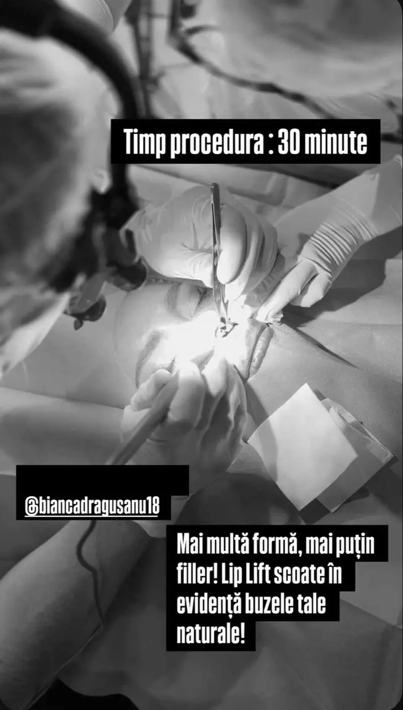 bianca dragusanu operatie estetica lip lift  (1)