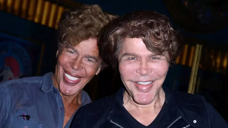 Cea mai nereușită operație estetică din lume. Rezultat sinistru pentru doi frați gemeni, cândva mari vedete în Europa