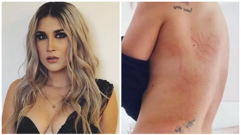 Cum a luat Adda, de fapt, boala Lyme de la mama ei: „S-a întâmplat cel mai probabil...”