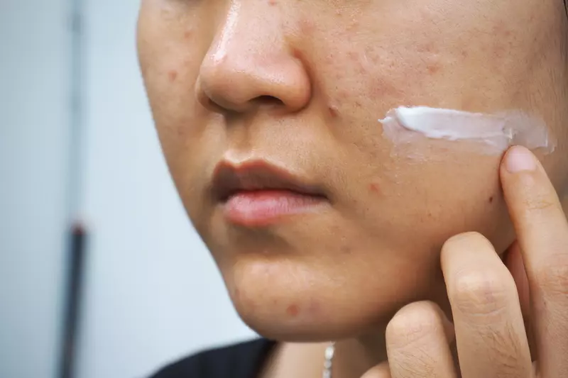 Crema naturală din lămâie pentru cicatrice