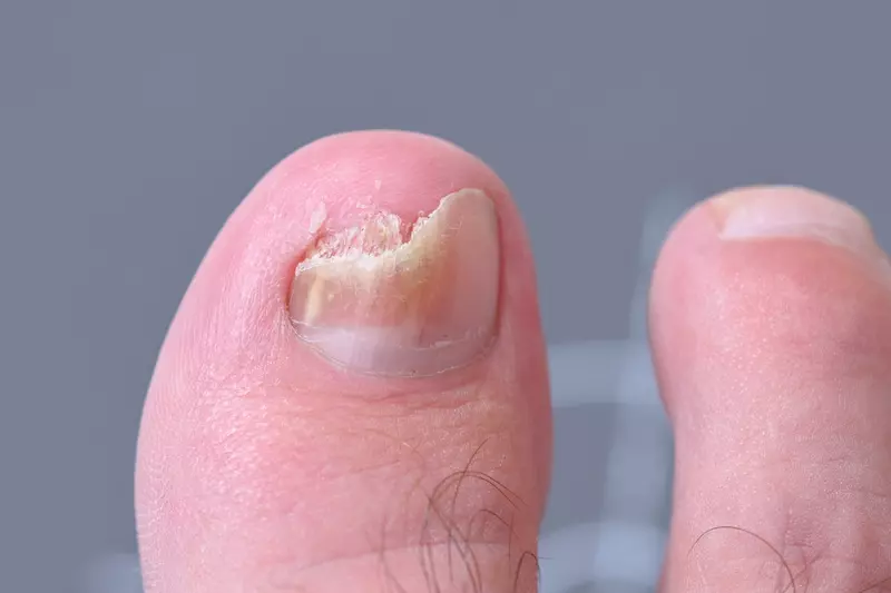 mycosis Fungal infection of the big toe nails. Fungal infection