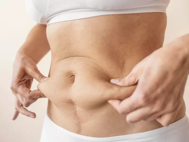 Avantajele liposucției: Când și în ce condiții să alegi această intervenție?