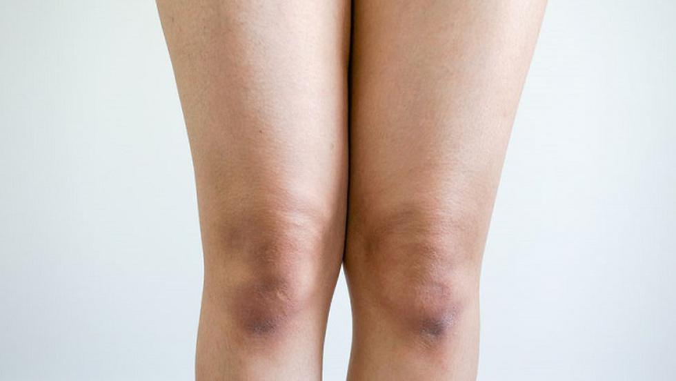 tratament cu ebonita la genunchi