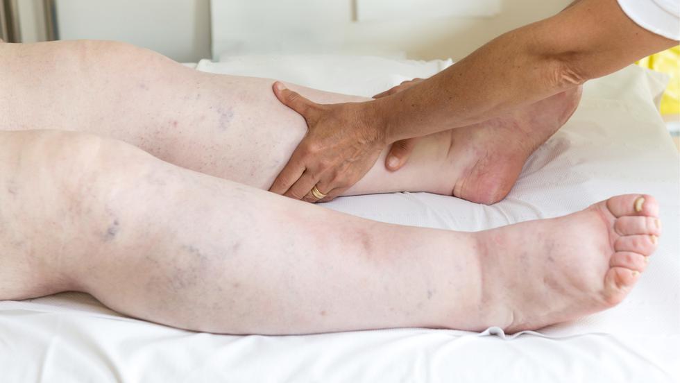 Umflarea picioarelor - CSID: Ce se întâmplă Doctore?