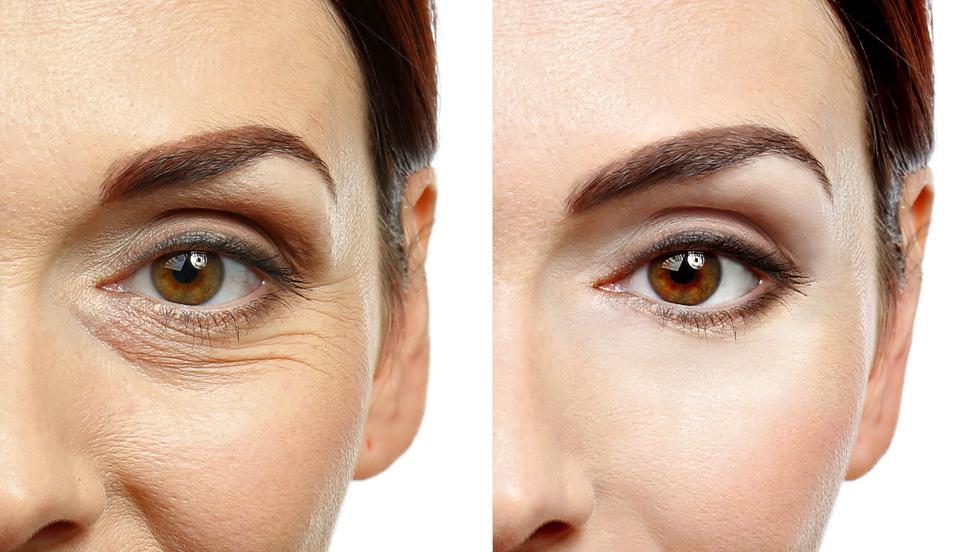 riduri fine sub ochi ce să faci piele grasă anti-îmbătrânire