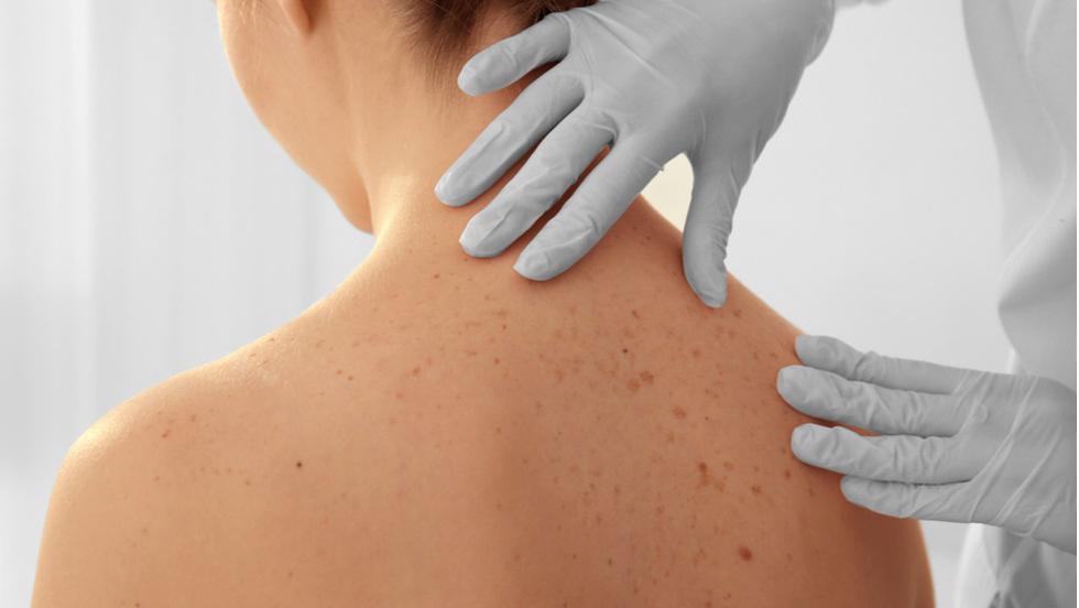 Tipuri de cancer de piele – cum le recunoști și cum se tratează